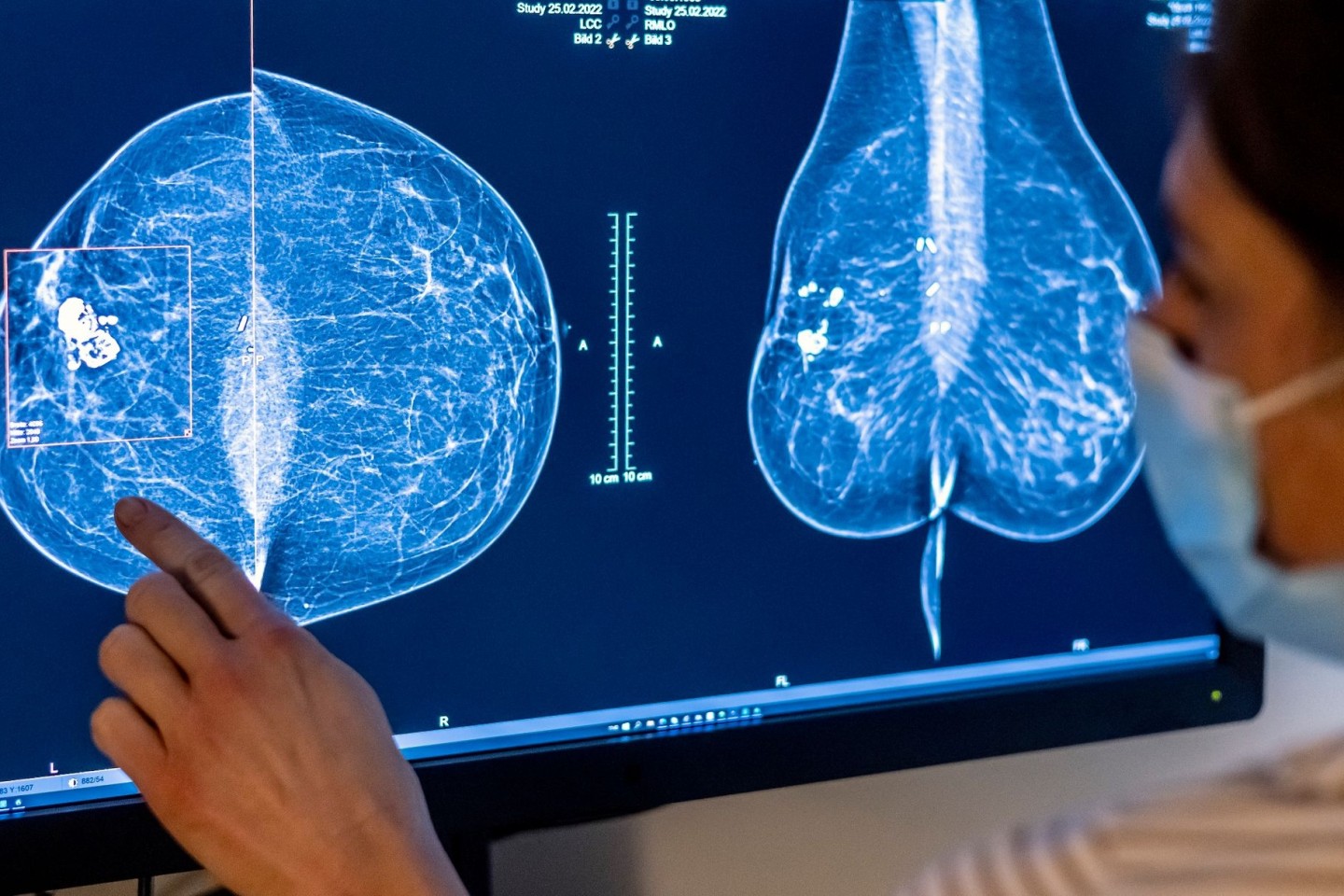 Brustkrebs ist die häufigste Krebserkrankung bei Frauen in Deutschland.