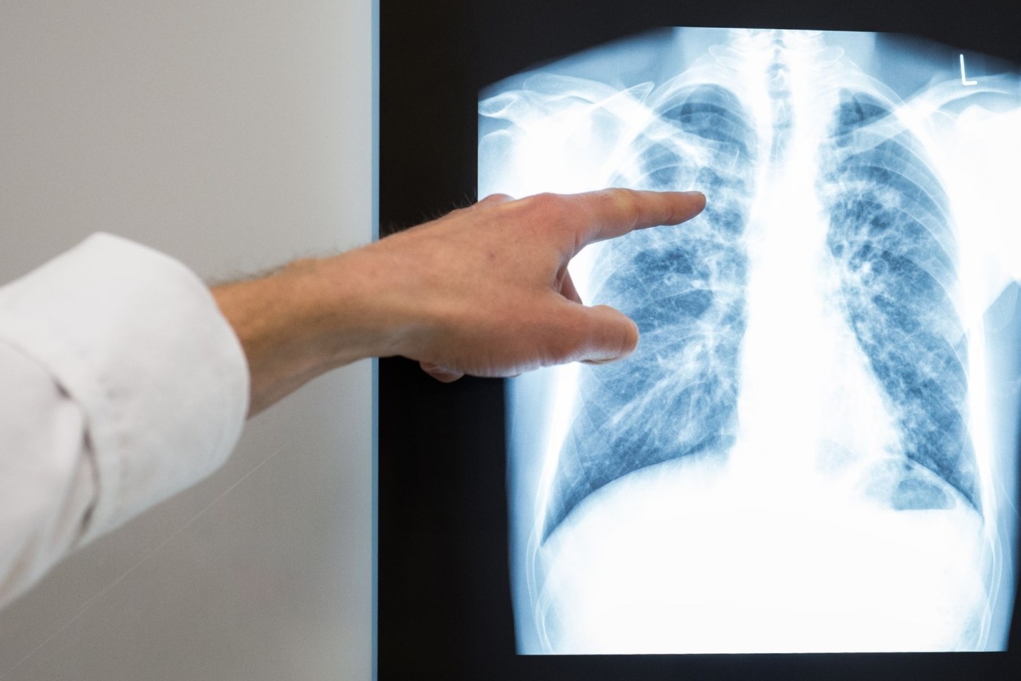 Röntgenbild einer Lunge. Im vergangenem Jahr würden rund 4480 neue Tuberkulose-Fälle in Deutschland registriert.